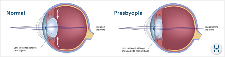 Presbyopia Problems