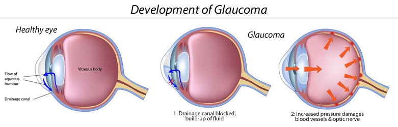 glaucoma