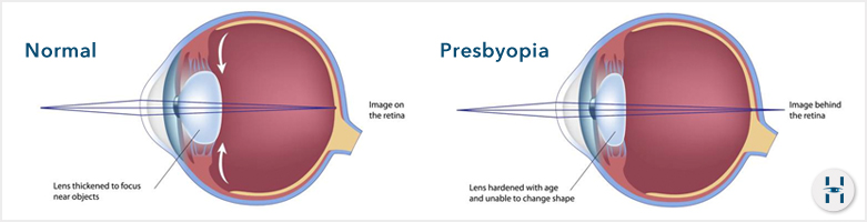 Presbyopia Presbyopia: A