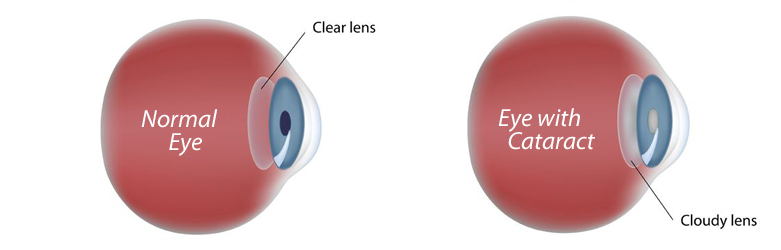 Cataract Surgery